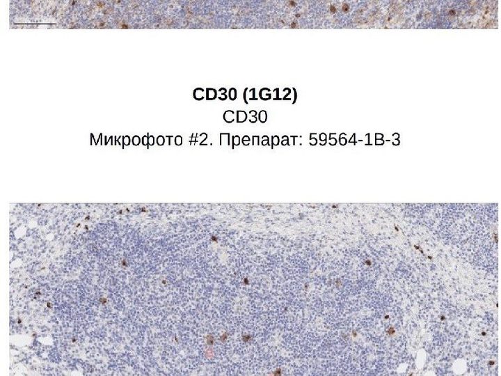 Иммуногистохимическое окрашивание биоптата: реакция клеток с CD30 и CD15