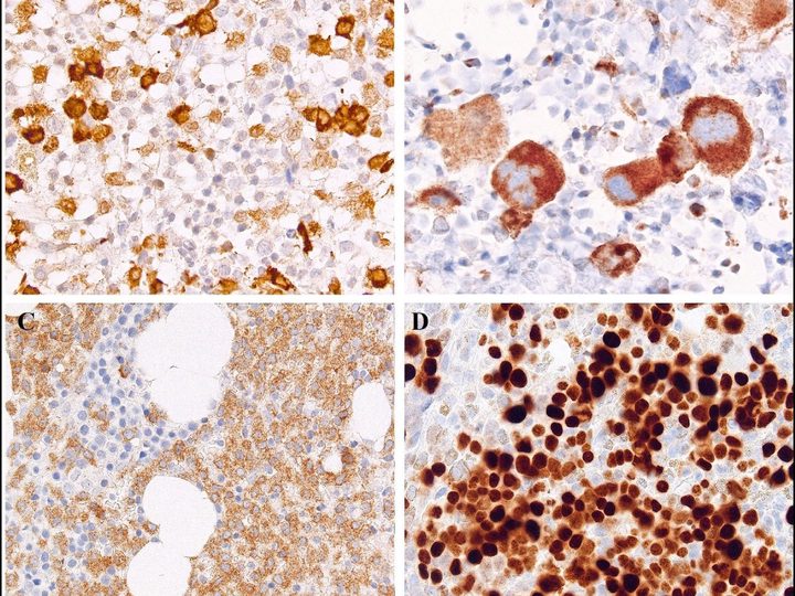 Trephine biopsy micropreparations with immunohistochemical staining of markers