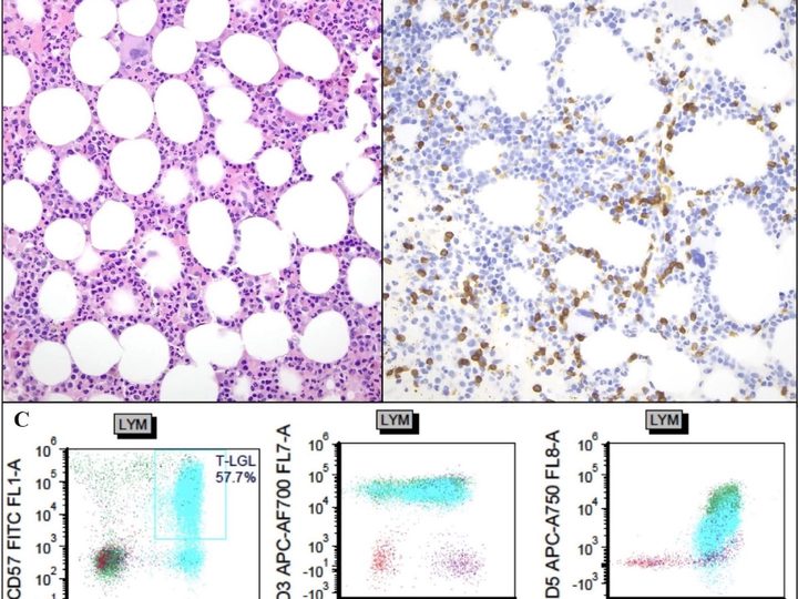 Histological section of trephine biopsy, IHC, and flow cytometry graphs