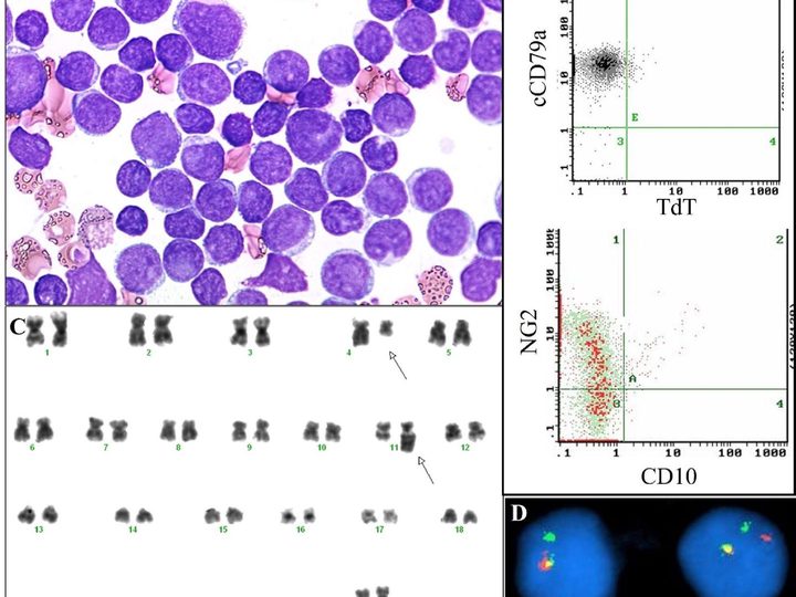 Bone marrow smear with blasts, cytometry graphs, karyogram, and FISH