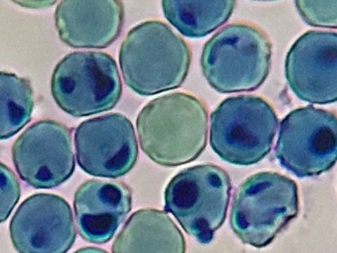Мазок крови: цитохимическое выявление метгемоглобина в популяции эритроцитов