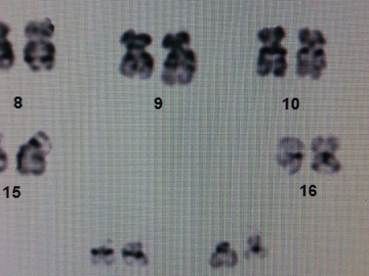 Monitor screen, fragment of karyotype with t(9;22) translocation in CML