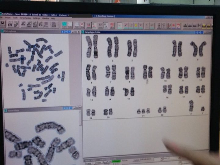 Monitor screen, karyotype layout with trisomy of chromosome 21