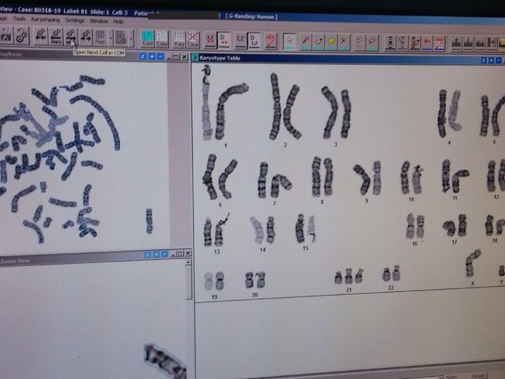 Monitor screen with karyogram 47,XY,+21 in Down syndrome