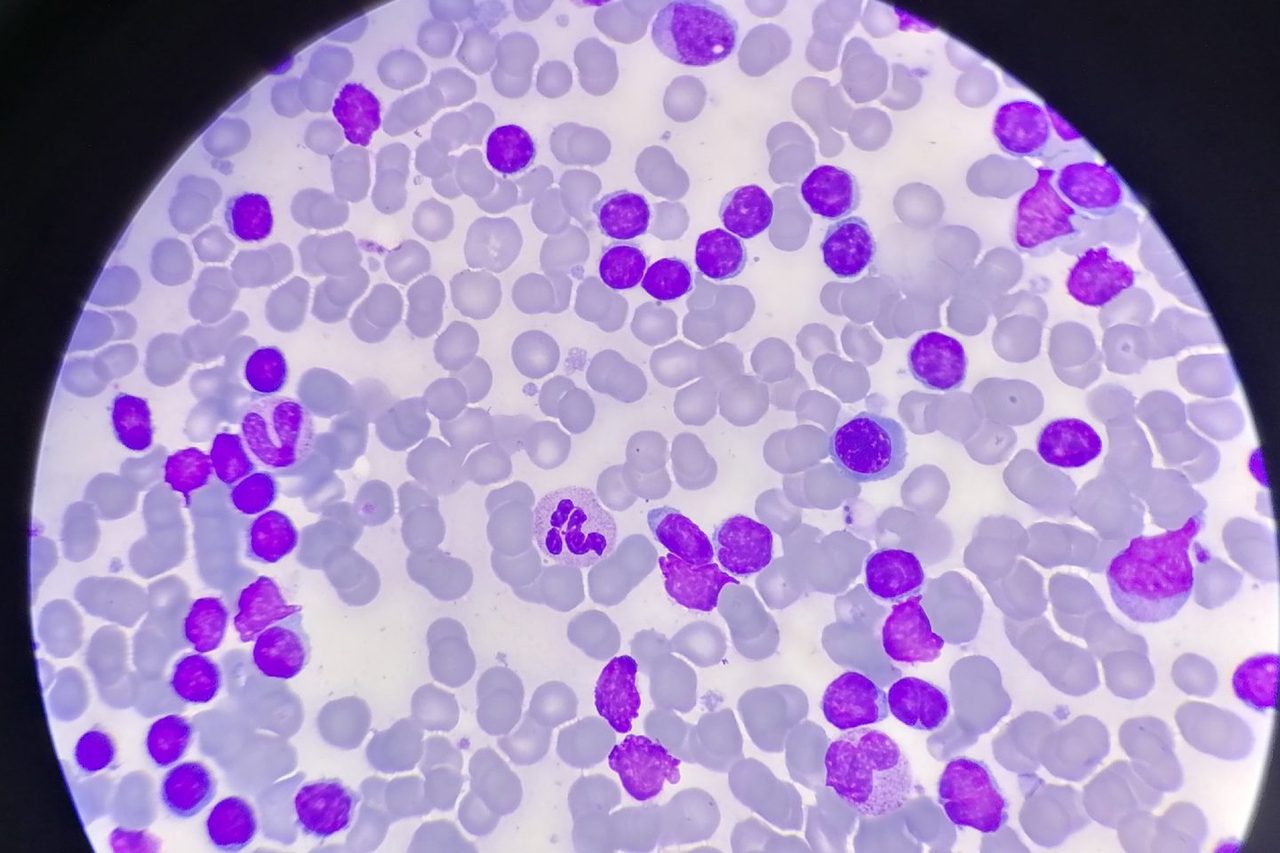 Blood and Bone Marrow Findings in Chronic Lymphocytic Leukemia