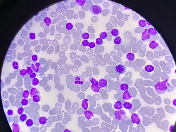 Bone marrow aspirate smear: infiltration with mature lymphocytes and Gumprecht shadows