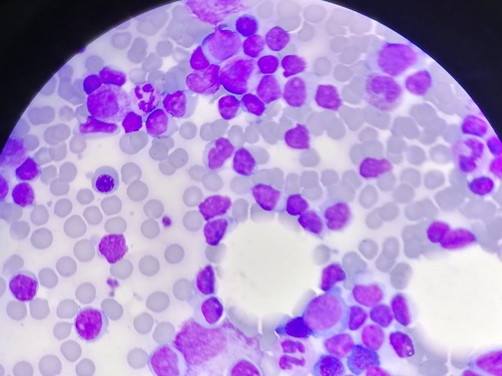 Bone marrow smear: massive accumulation of tumor lymphocytes amidst fat droplets
