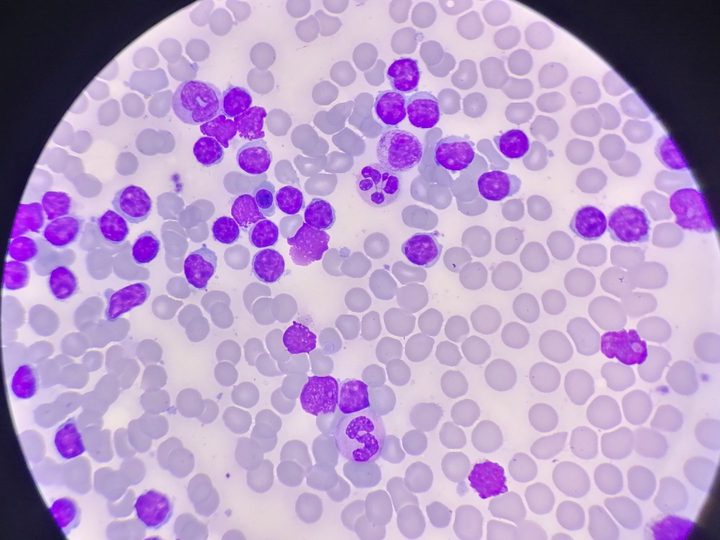 Bone marrow aspirate smear: lymphocytes with condensed chromatin and a cytolysis cell