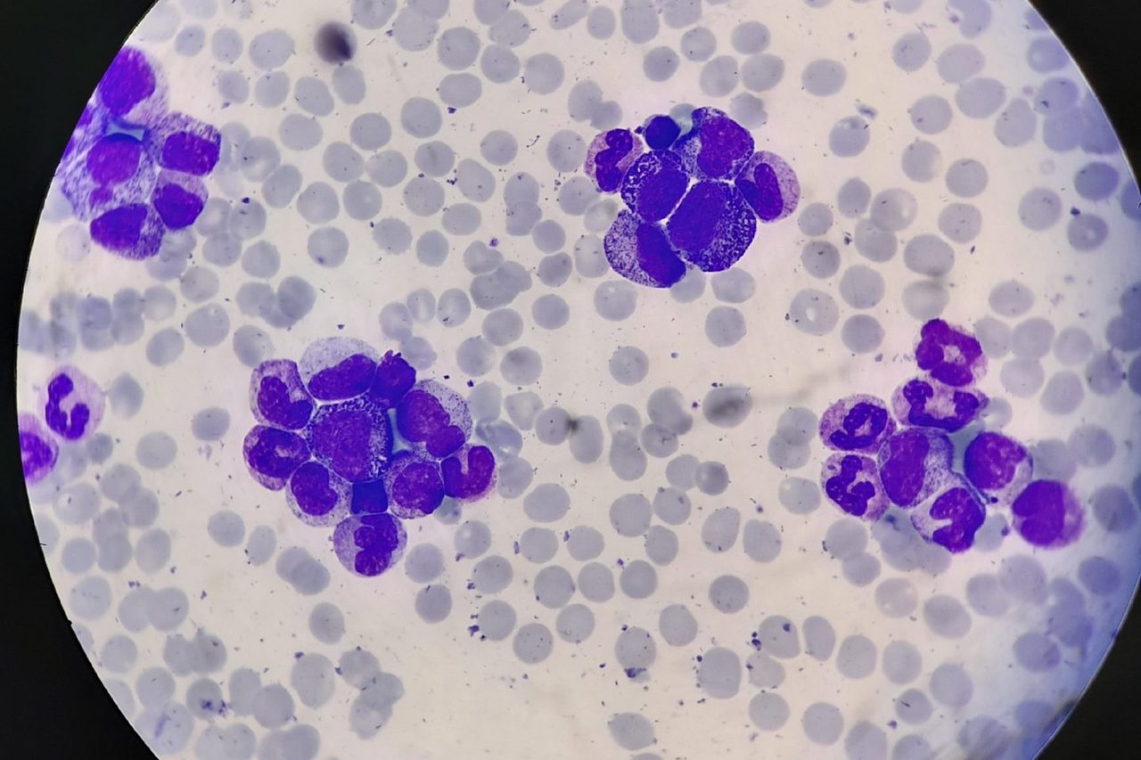Blood Picture in Suspected Chronic Myeloid Leukemia