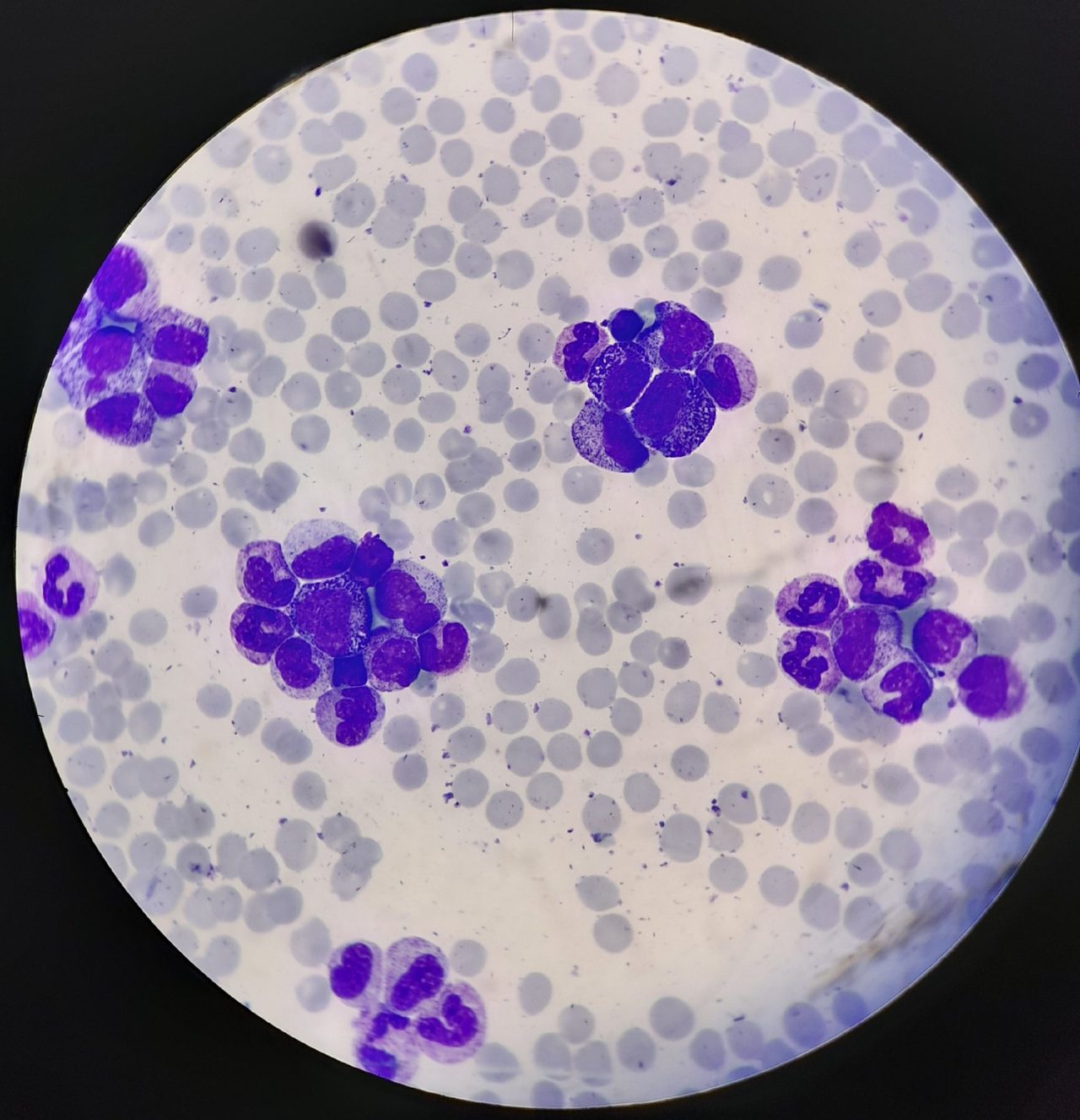 Blood Picture in Suspected Chronic Myeloid Leukemia