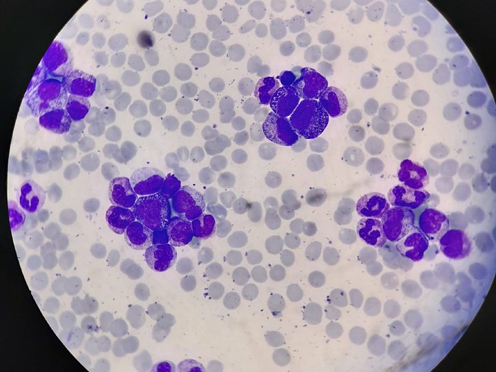 Blood smear: clusters of granulocytes of various maturation stages