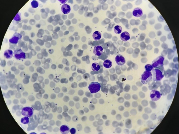 Blood smear: pronounced leukocytic left shift