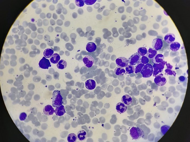 Blood smear: promyelocytes, myelocytes, and mature neutrophils in the field of view