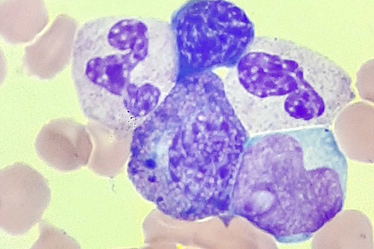 Harlequin Cells in Peripheral Blood Smear in Acute Myeloid Leukemia