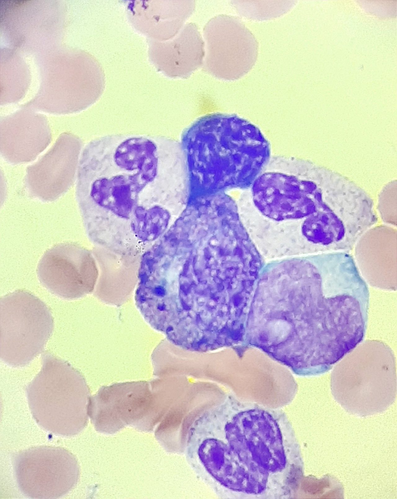 Harlequin Cells in Peripheral Blood Smear in Acute Myeloid Leukemia