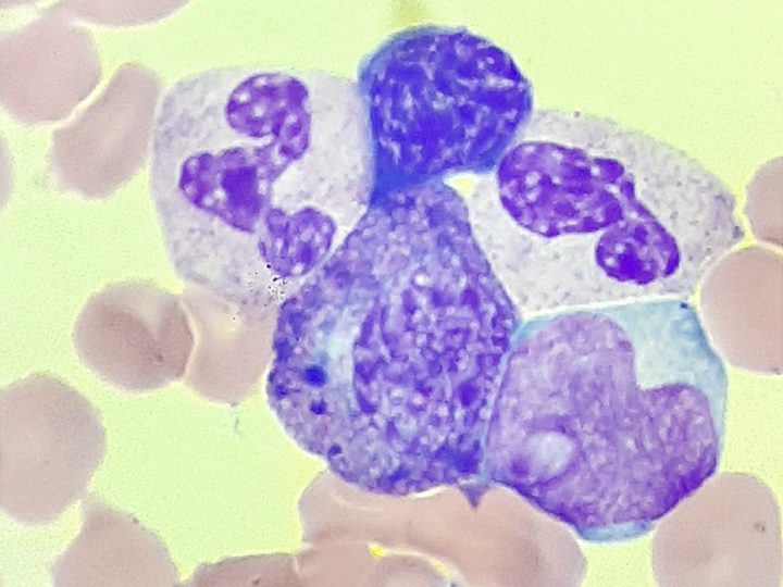 Blood smear: neutrophils and a Harlequin cell with pathological granulation