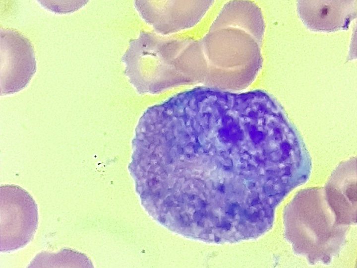 Blood smear: Harlequin cell with massive cytoplasmic granularity