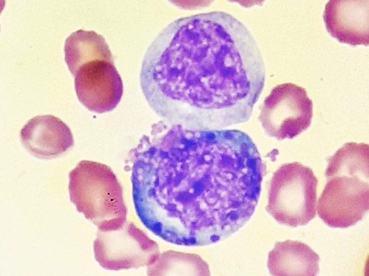 Blood smear: granulocyte with abnormal cytoplasmic granularity in AML