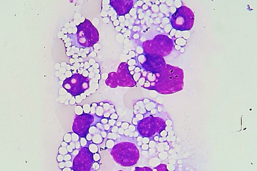 Mott Cells in Peripheral Blood: Morphology