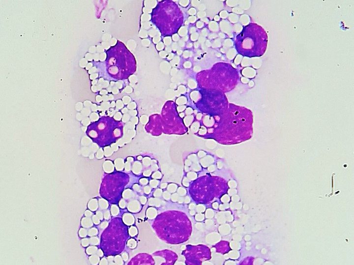 Peripheral blood smear: cluster of atypical Mott cells with Russell bodies
