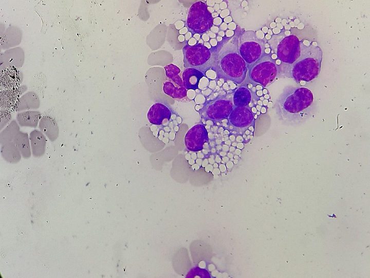 Blood smear: group of plasma cells and Mott cells with morula-like cytoplasm