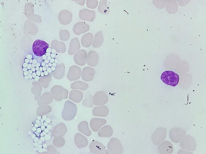 Peripheral blood smear: Mott cells with vacuole-like protein inclusions