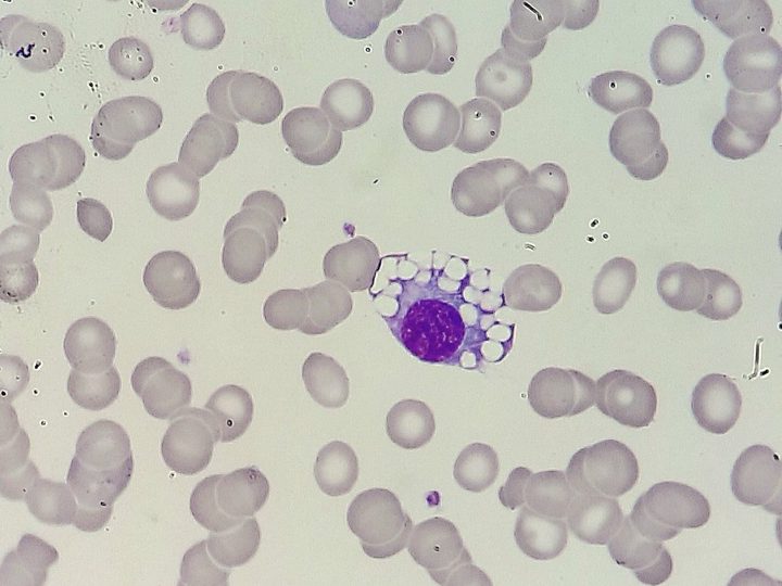 Blood smear: isolated Mott cell with eccentric nucleus and clusters of inclusions