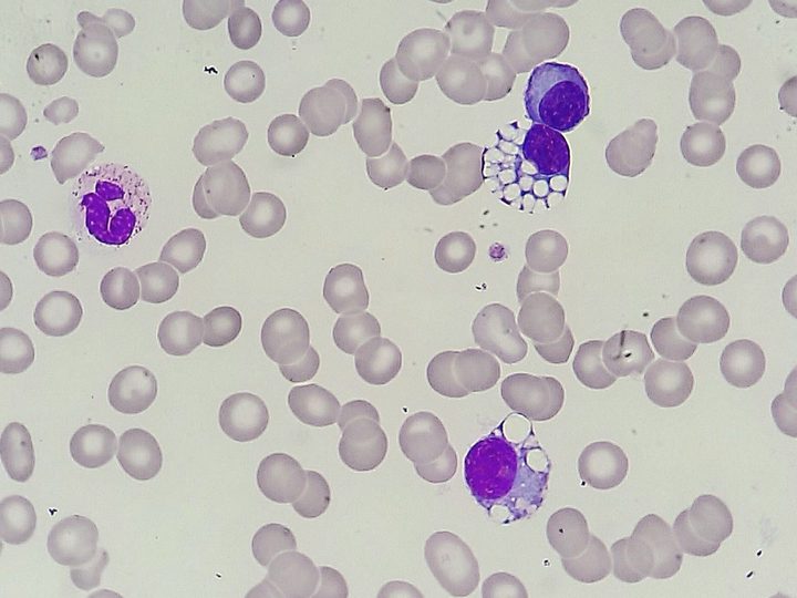 Blood smear: Mott cell and plasma cell next to a neutrophil