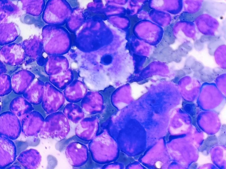 Bone marrow smear: pseudo-Gaucher cell among granulocytic series cells in CML