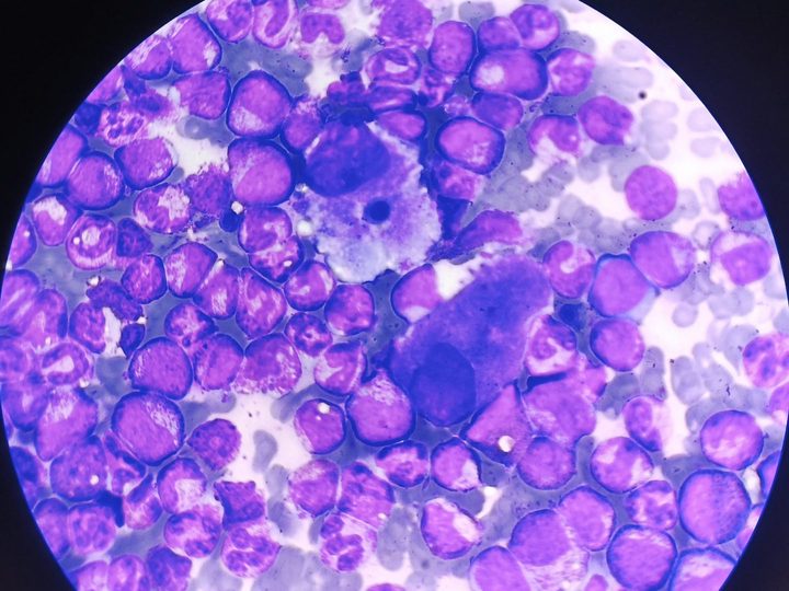 Bone marrow smear: overview field of view with hypercellularity and a pseudo-Gaucher cell