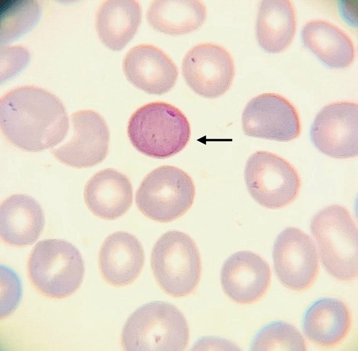 Bone marrow smear: Cabot ring inside an erythrocyte, indicated by an arrow