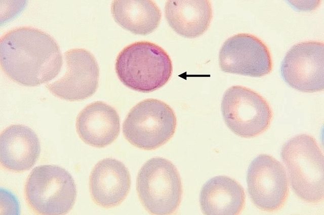 Cabot Rings in Erythrocytes: Morphology and Diagnostics