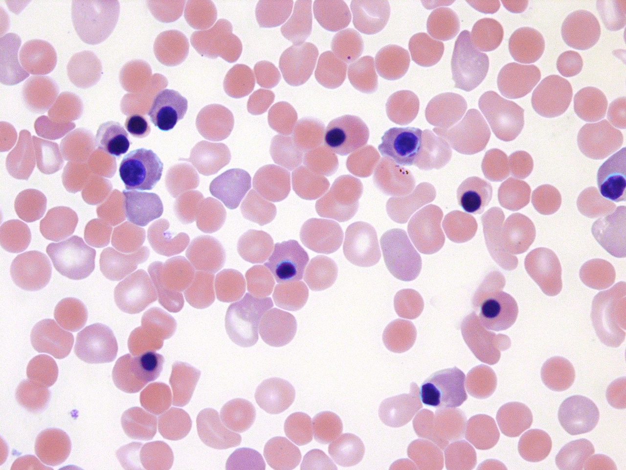 WBC Correction for Normoblasts in Peripheral Blood Smear