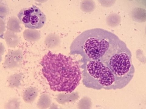 Мазок костного мозга: гигантский гранулоцит и ядро мегалобласта