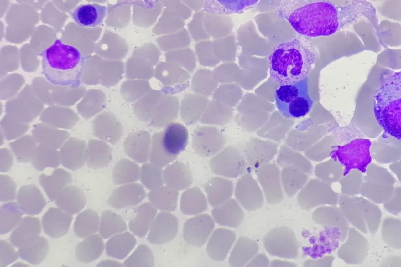 Bone Marrow in Polycythemia Vera: A Clinical Case