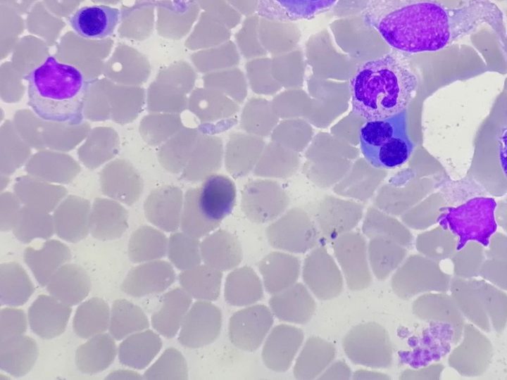 Bone marrow smear: normoblasts and maturing granulocytes