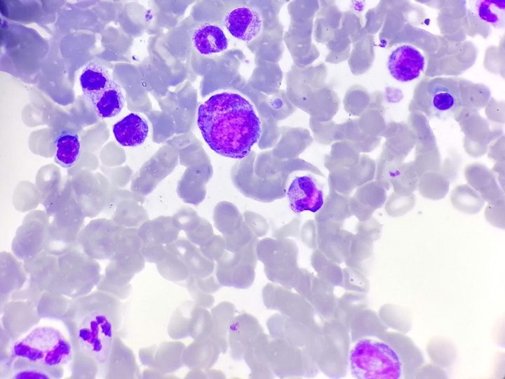 Bone marrow smear: myelocyte and erythroblasts in the aspirate