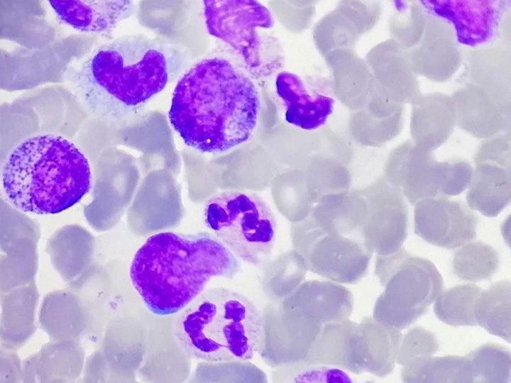 Bone marrow smear: normoblastic erythropoiesis and neutrophils
