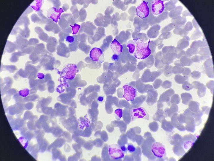 Bone marrow smear: myelopoiesis cells at different maturation stages