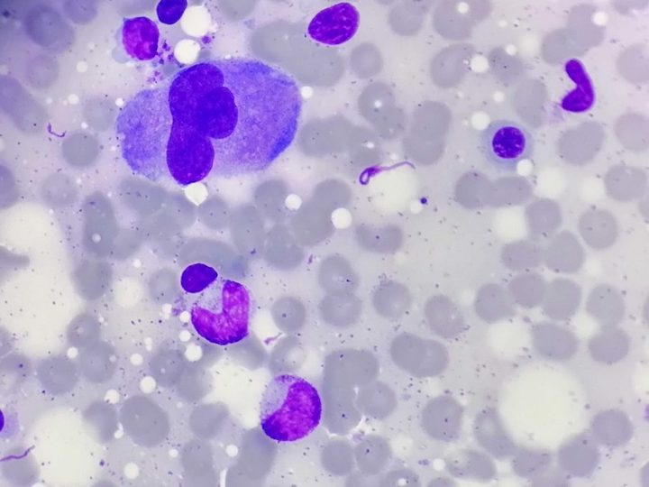 Bone marrow smear: megakaryocyte and granulocytic series cells