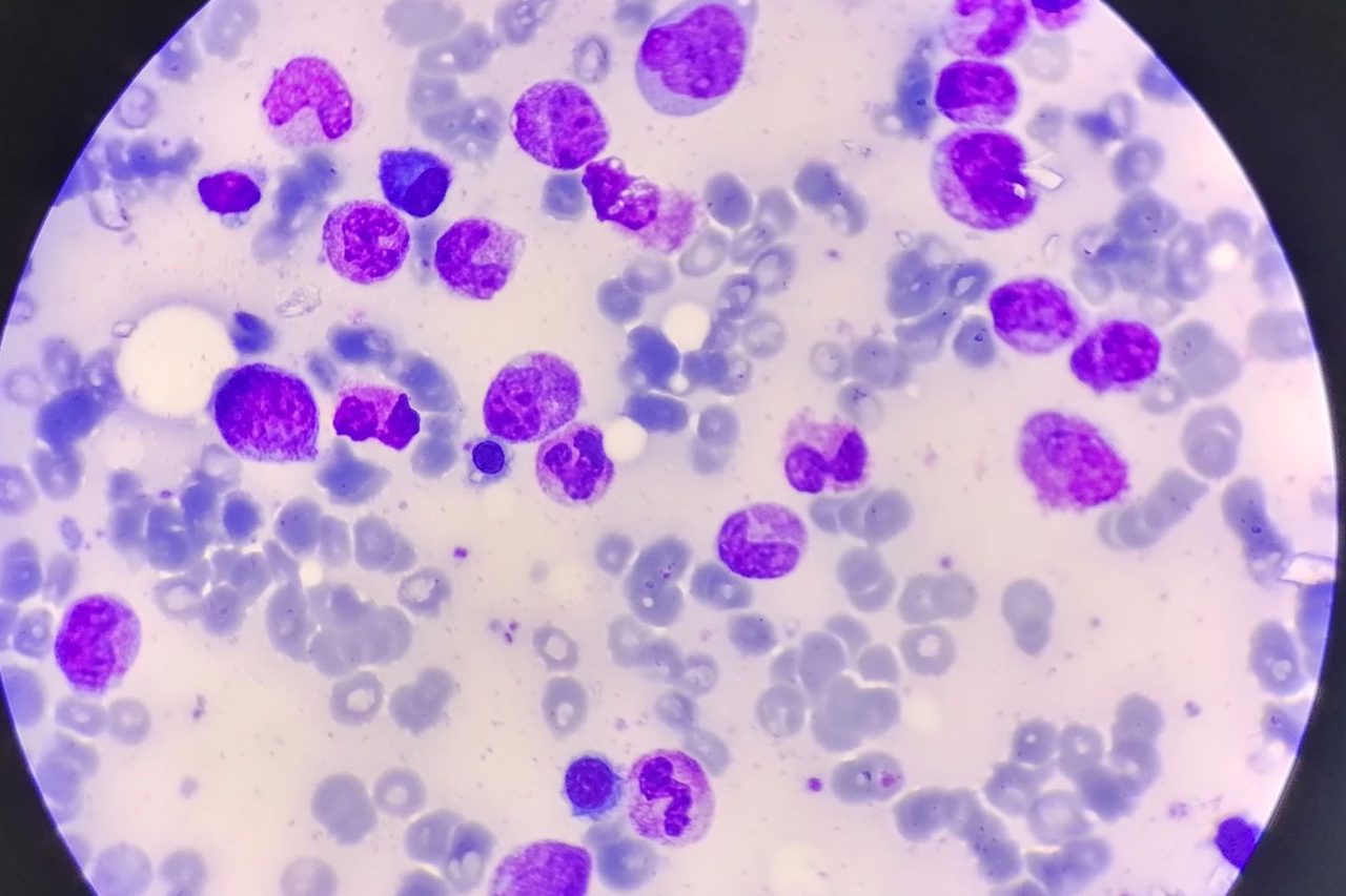Bone Marrow in Multiple Myeloma Remission: A Case Study