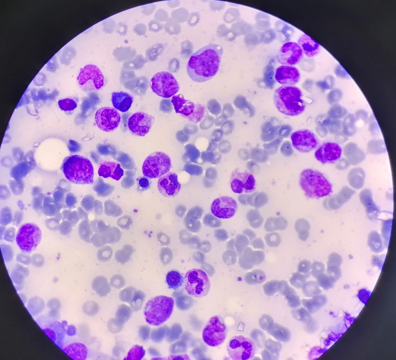 Bone Marrow in Multiple Myeloma Remission: A Case Study