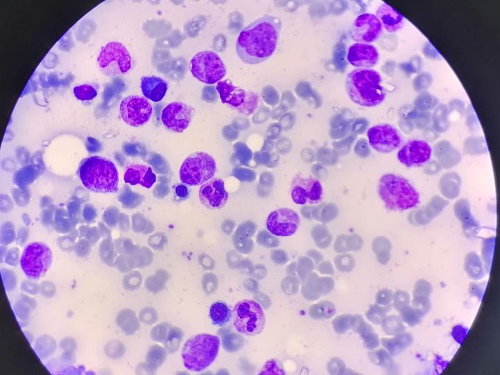 Bone marrow smear, mature plasma cell among normoblasts and granulocytes