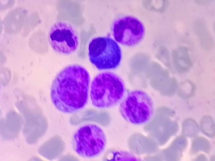 Bone marrow smear, mature plasma cell with perinuclear clearing