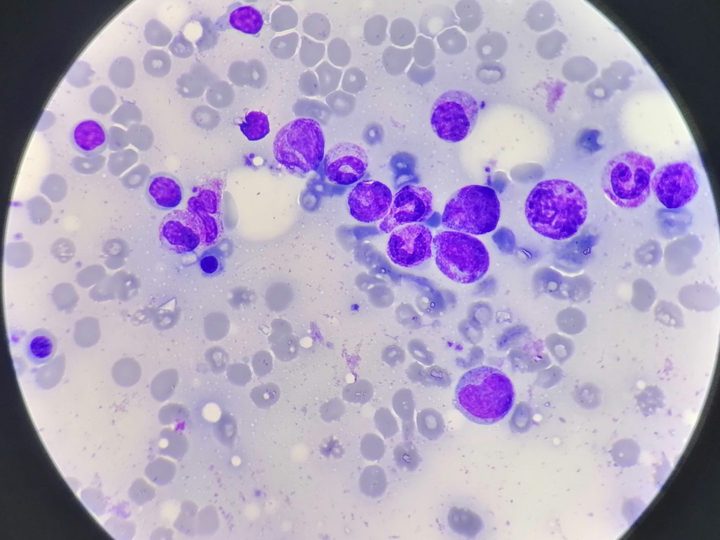 Bone marrow smear, preserved hematopoiesis without pathological infiltration