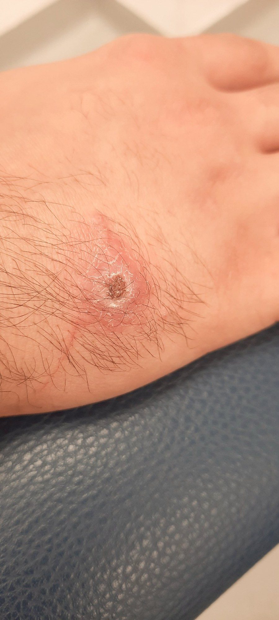 Cutaneous Leishmaniasis: Morphology of Leishmania major and Diagnostics