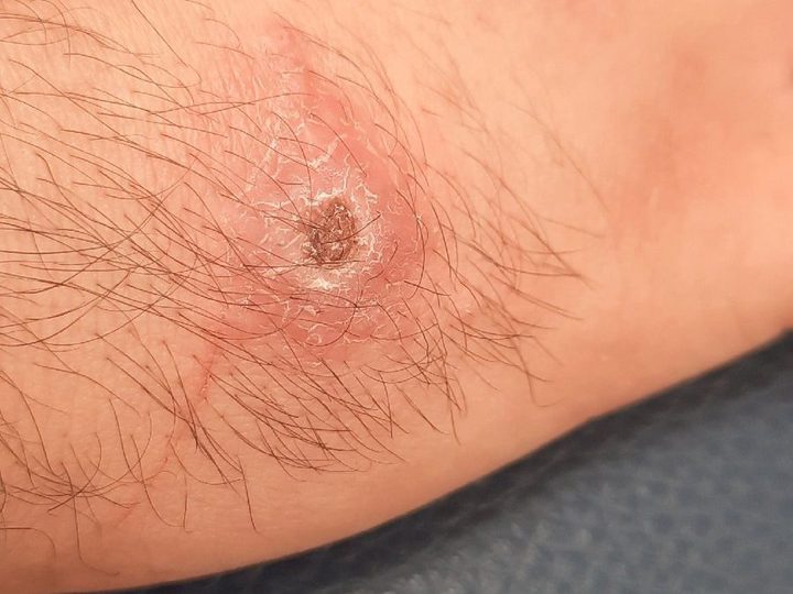 Macrophoto of a skin lesion: ulceration with a crust on the hand