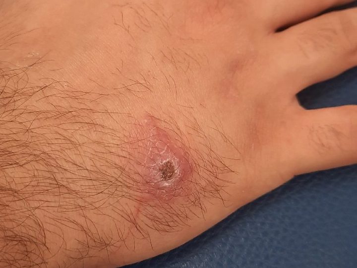 Appearance of an ulcerative lesion on the back of the hand