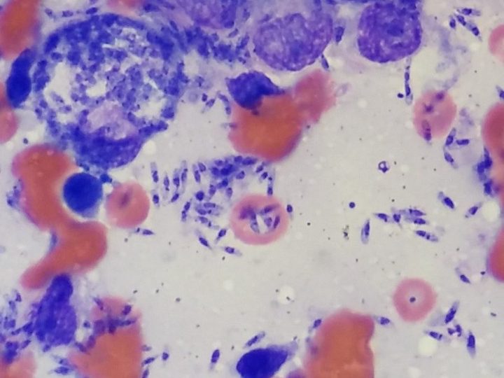 Smear-impression from the lesion: Leishmania amastigotes in macrophages