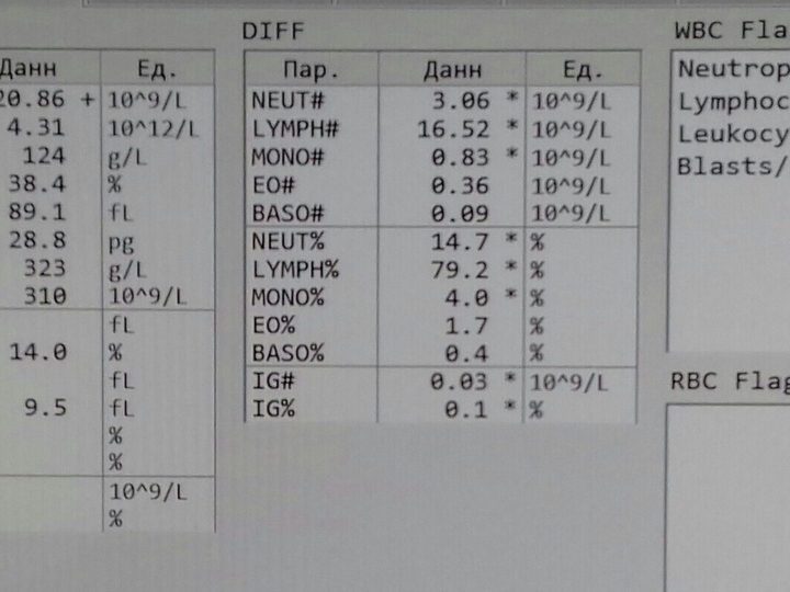 Распечатка анализатора: лейкоцитоз 20,86×10⁹/л и выраженный лимфоцитоз